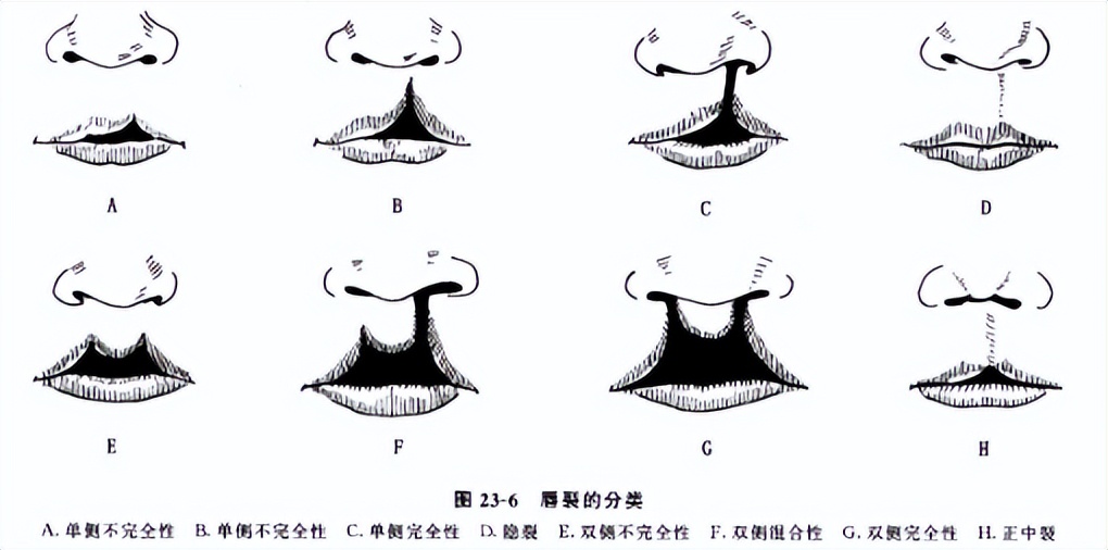 唇裂鼻畸形一期,隐形唇裂会越来越严重吗