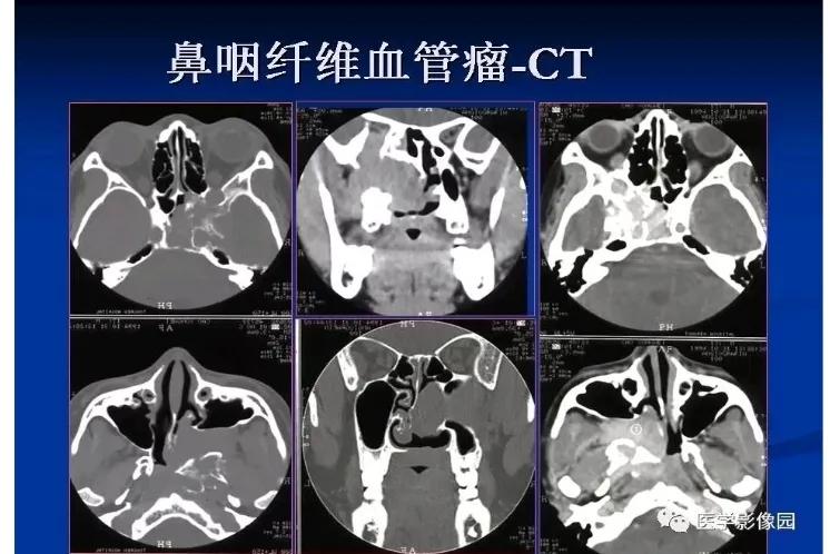 鼻出血介入治疗,鼻出血快速止血