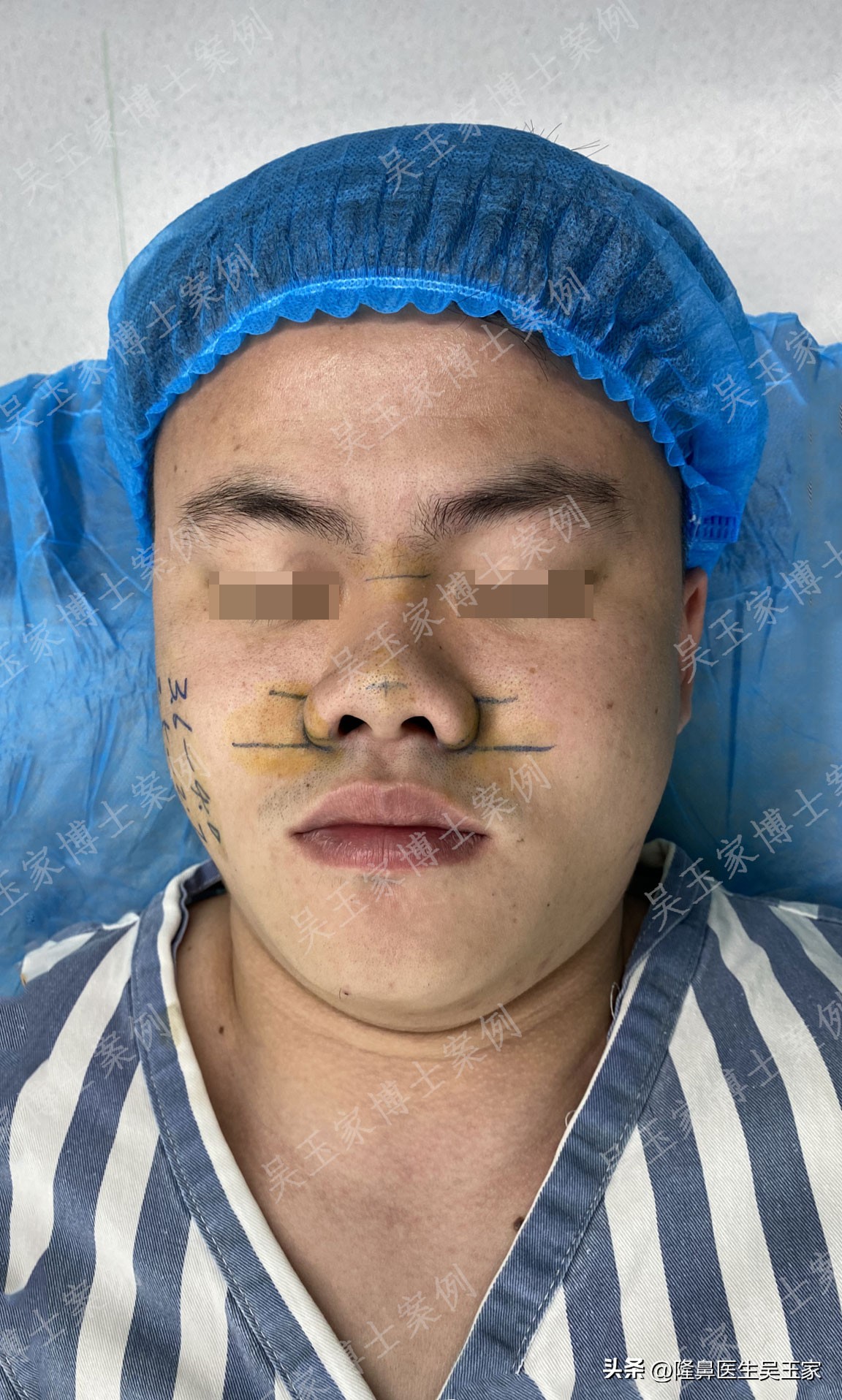 鼻头大整容前后男,鼻头肥大鼻翼宽做手术