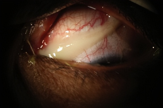 一图读懂细菌性结膜炎,细菌性结膜炎图例