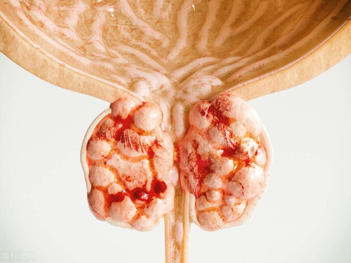 前列腺增生中医上是阳虚还是阴虚,前列腺增生小便困难用什么药好呢