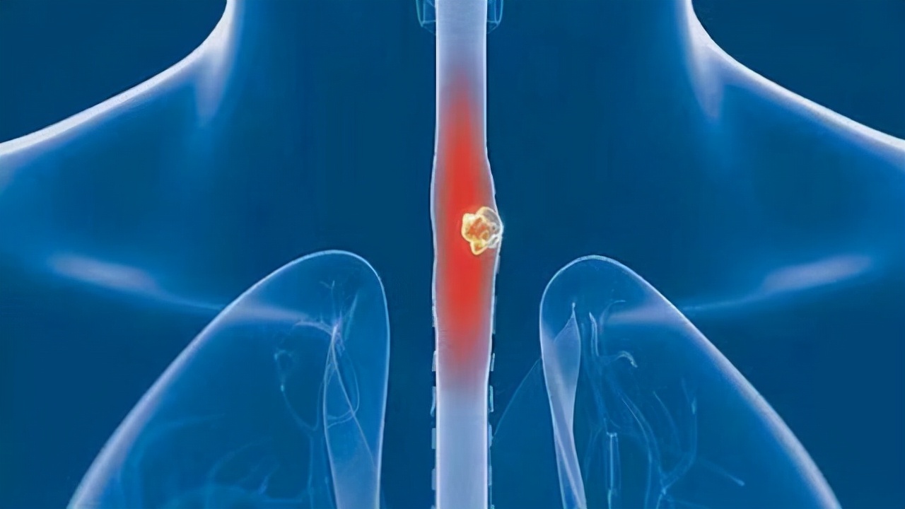 食管癌健康之路,食管癌晚期抗癌真实记录