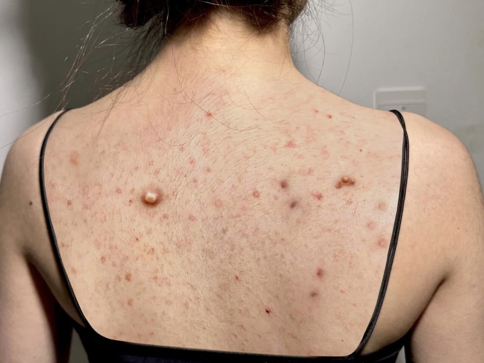 螨虫沐浴露国货,除螨虫沐浴露真实测评