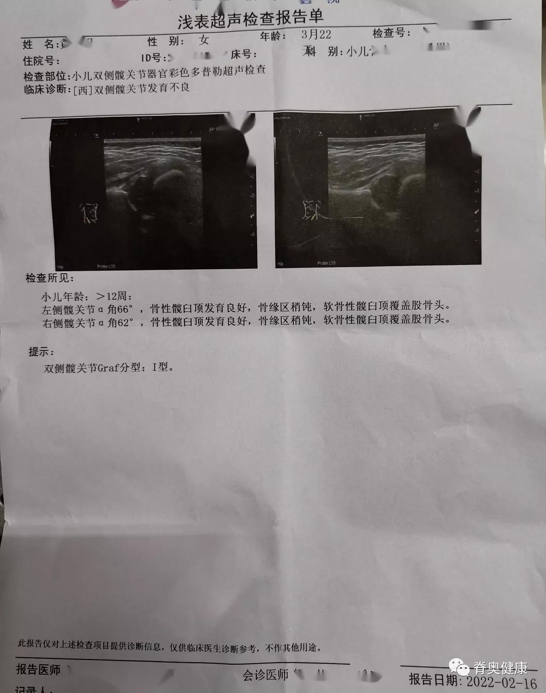 脊奥健康｜婴幼儿矫正案例—先天性髋关节发育不良+Tübingen支具
