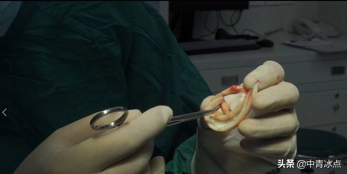 还记得西安疫情中117个脑袋挂着“水球”的小耳症患者吗？主刀医生发微博着急做手术，后来呢？