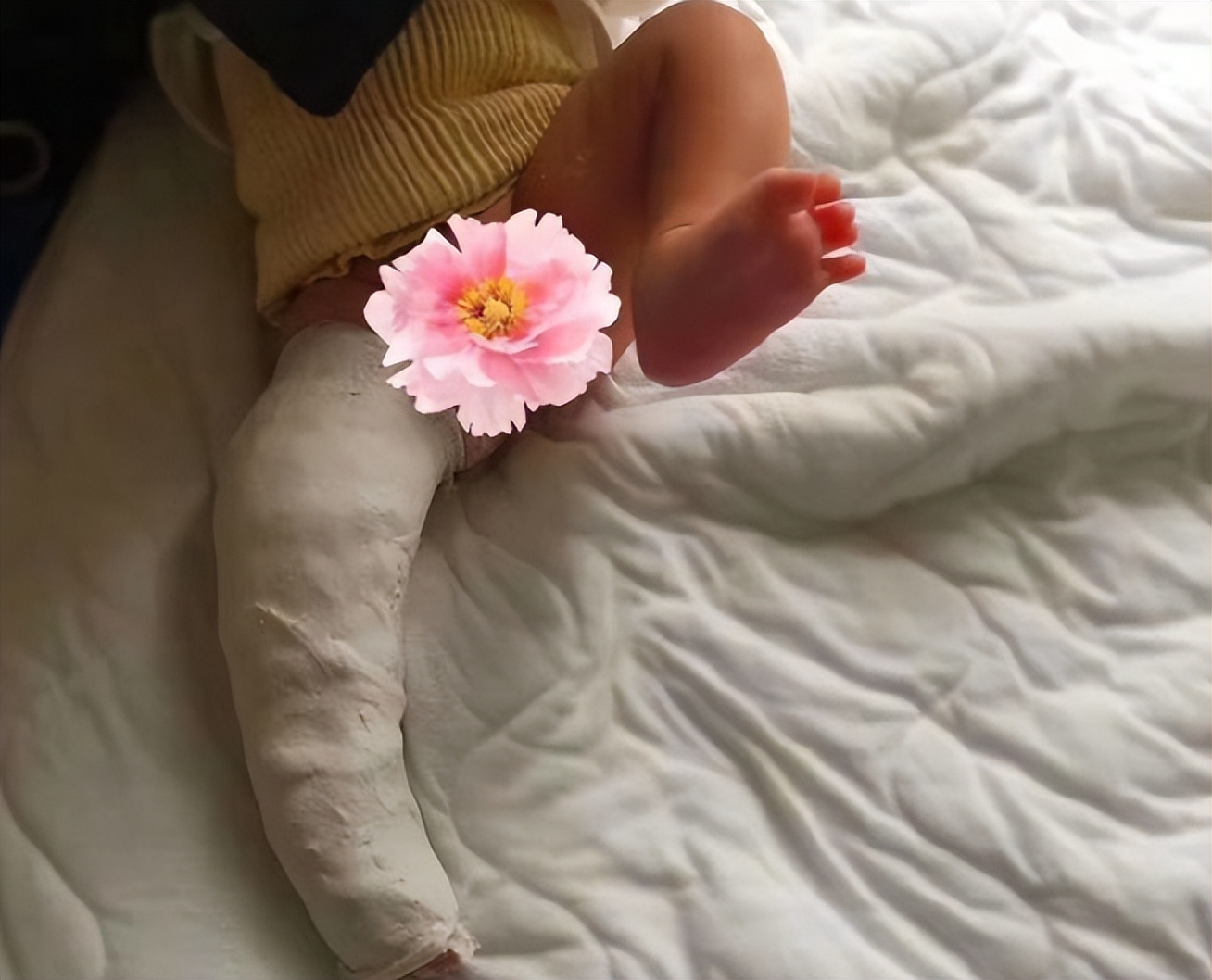 儿童股骨干粉碎性骨折对位不太好,儿童股骨干骨折石膏固定