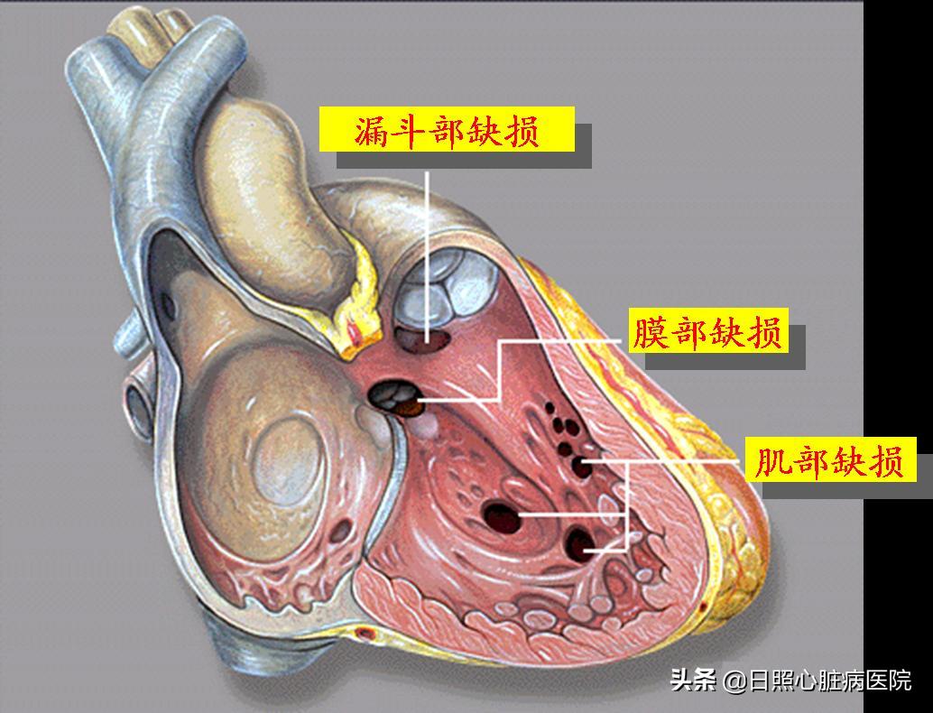 心脏室间隔缺损不治疗行吗,心脏有个洞要补吗