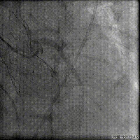 病例回顾与分享,腹膜后血肿介入治疗