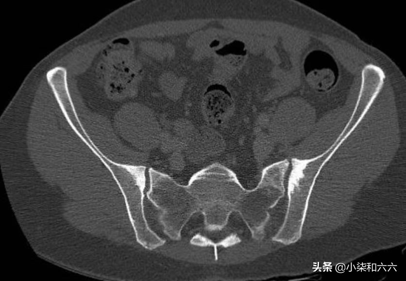 女性腰骶酸痛是怎么回事,致密性骶髂骨炎如何缓解