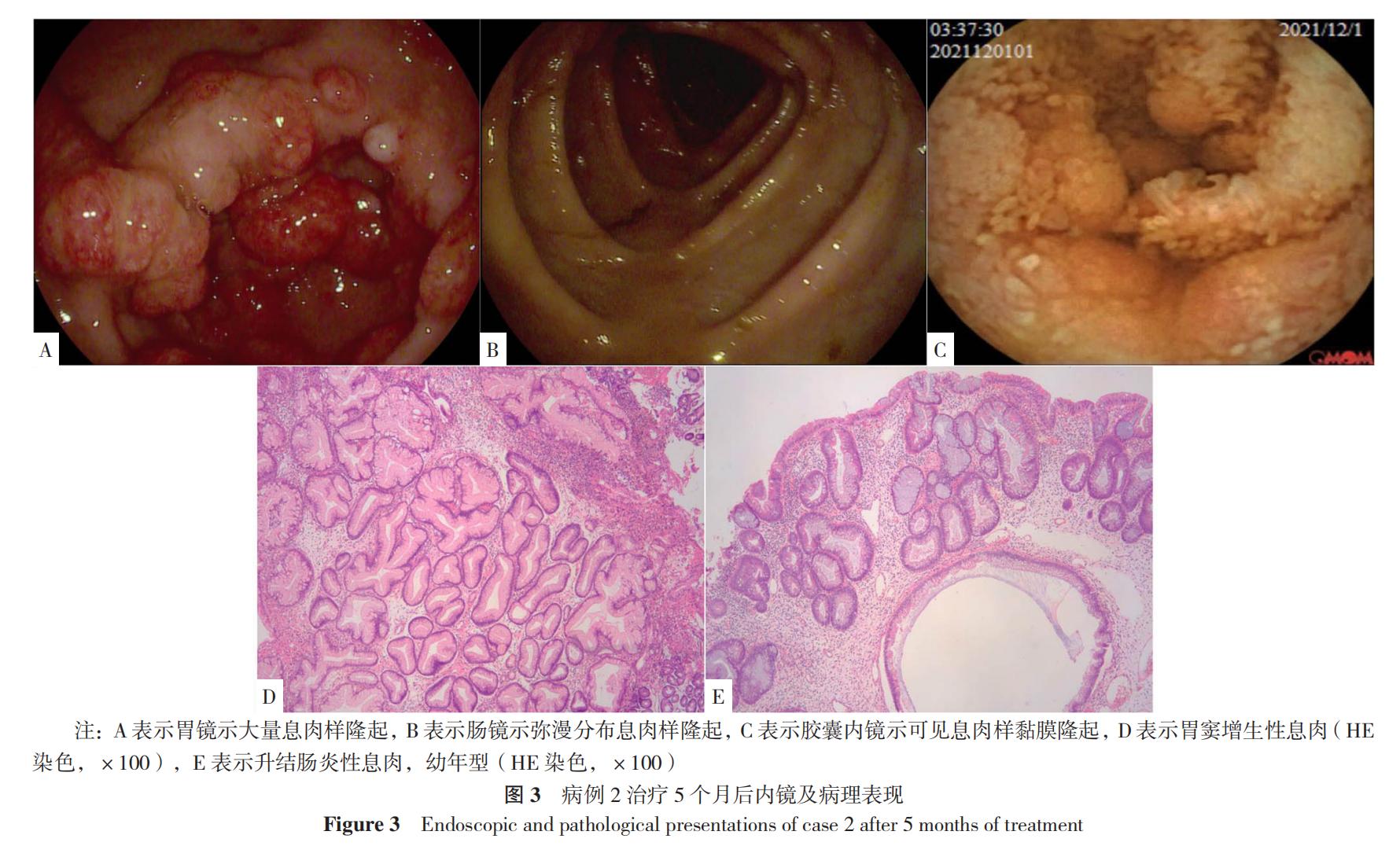 cronkhite-canada综合征能治愈吗 (cronkhite-canada综合征)