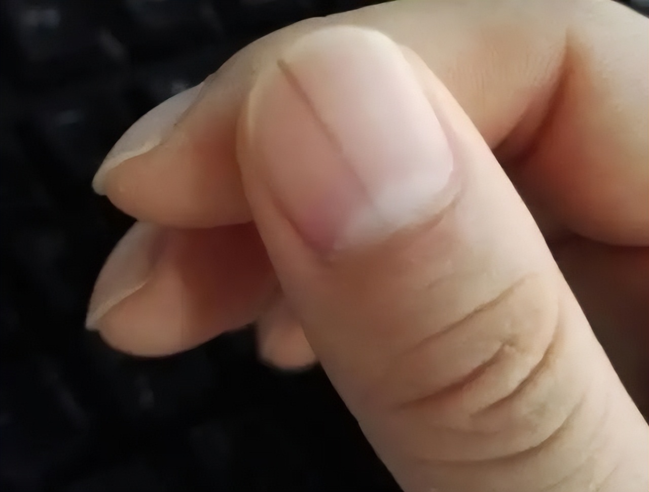 哪些部位有痣是癌症的预兆,蜘蛛痣长在哪里是癌症的表现