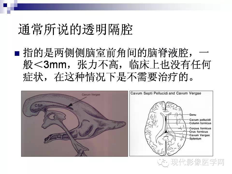 透明隔缺失影像学表现,透明隔腔影像