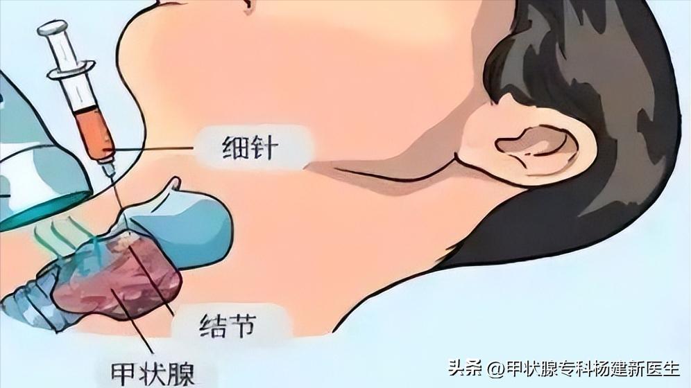 友谊医院甲状腺结节热消融手术,甲状腺结节什么条件可以做消融