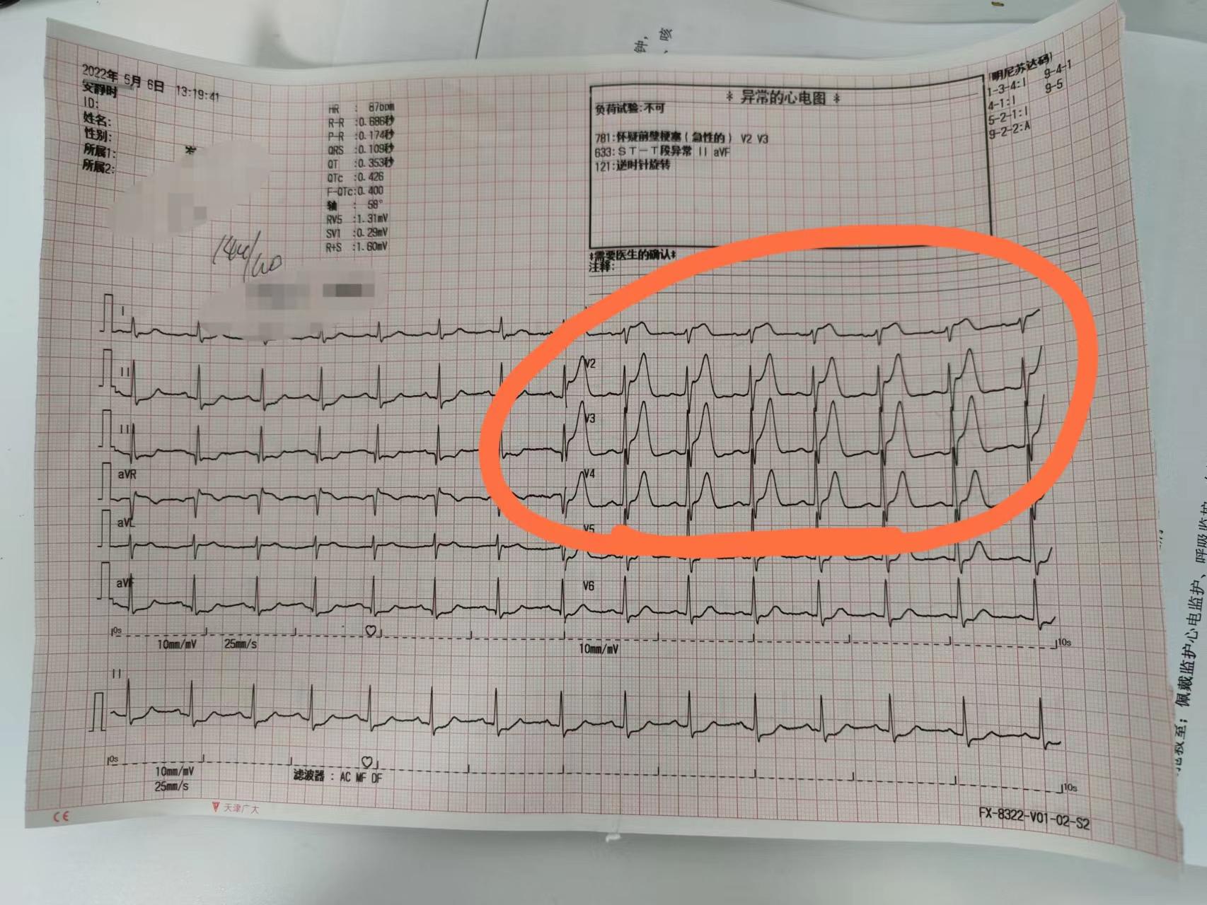 80岁老人得心梗无法手术无法溶栓,42岁突发心梗已下支架