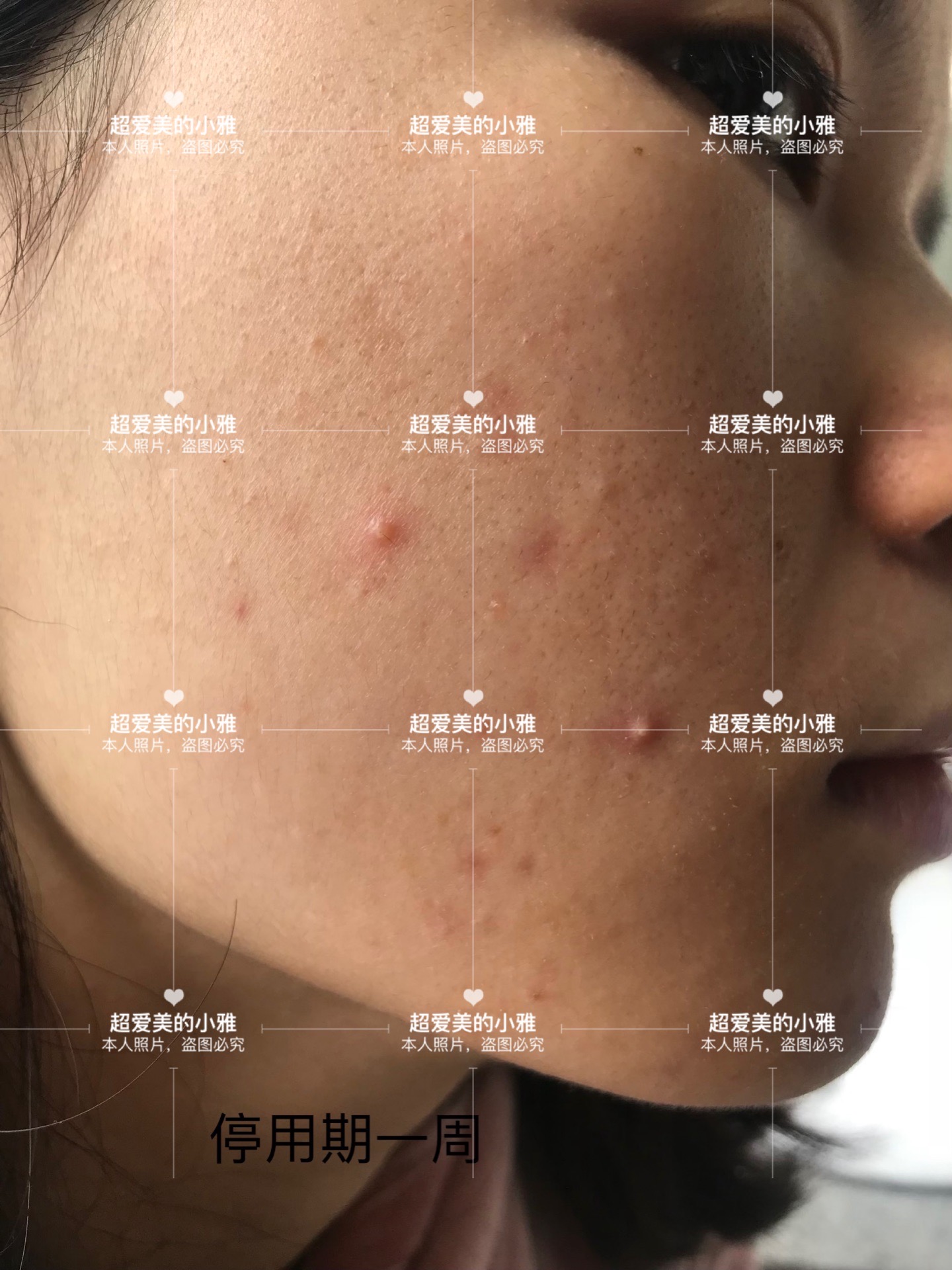 痘痘严重爆发如何战痘到底,痘痘的常见问题解决方法在这里