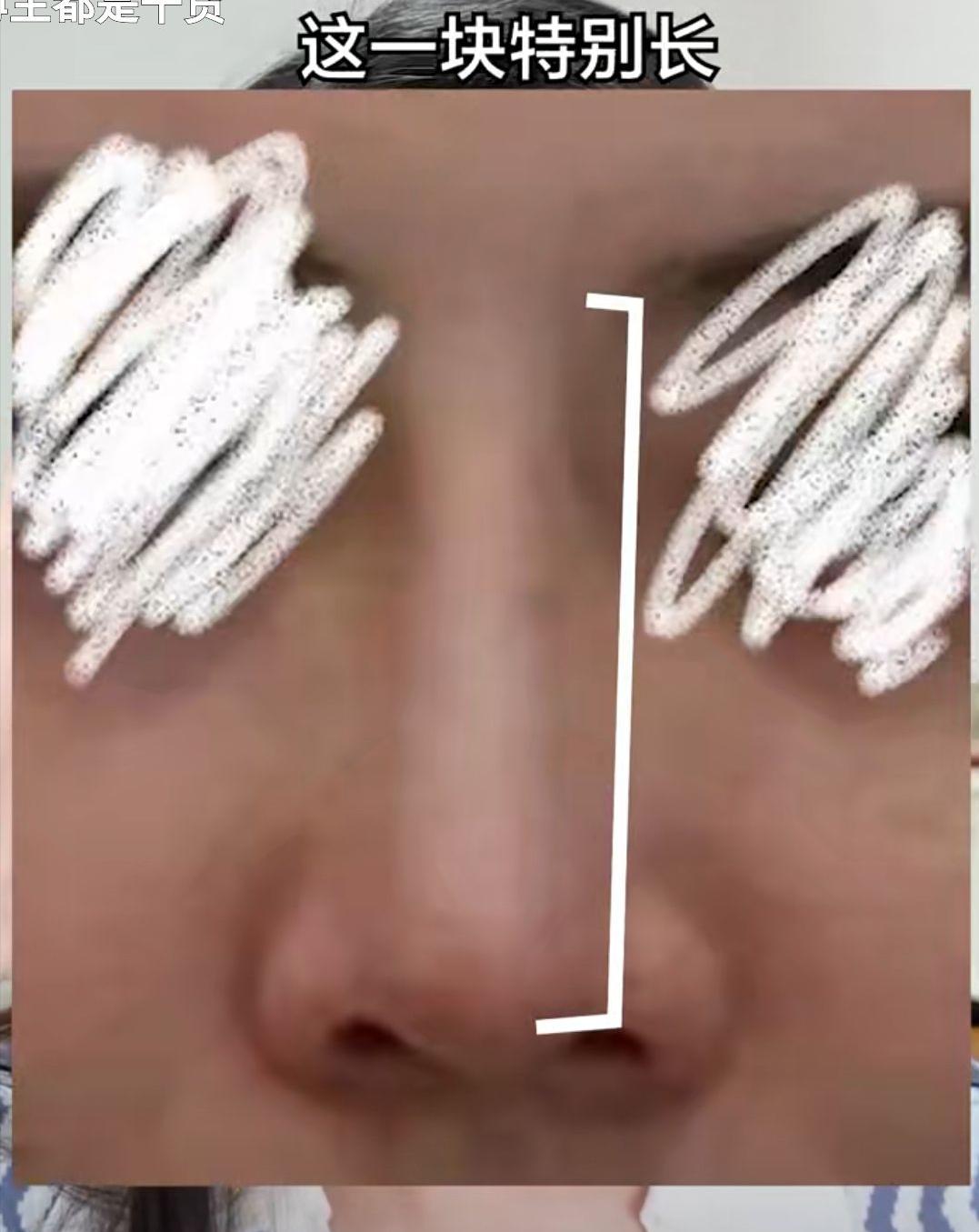 塌鼻子变美思路看这里,塌鼻梁怎么变漂亮