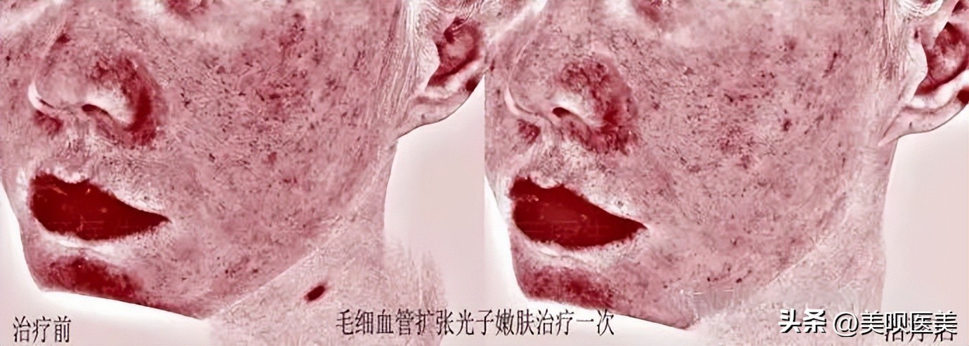 敏感肌换季大救星来了,换季敏感肌的正确使用方法