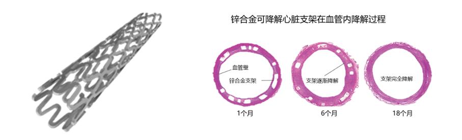 鍖荤敤鍙檷瑙ｉ攲鍚堥噾鐮旂┒鏂瑰悜,鍖荤敤閿屽悎閲戠殑鐮旂┒杩涘睍