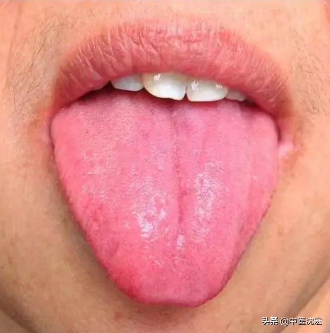 气虚自汗吃玉屏风散有用吗,头脸爱出汗吃玉屏风散有用吗