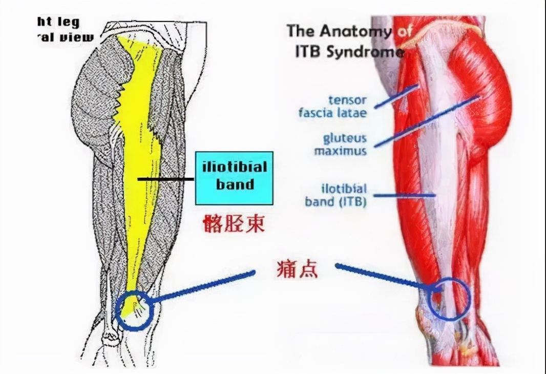 髂胫束会不会引起膝盖外侧疼痛,膝盖外侧髂胫束炎最好的治疗方法