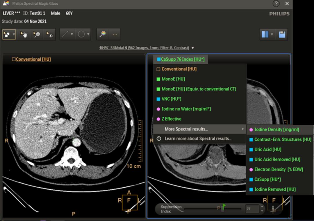 破冰者:飞利浦加速高端医学影像国产化