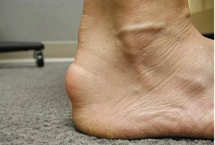 太马来了，跑友们要注意足踝部的运动损伤！