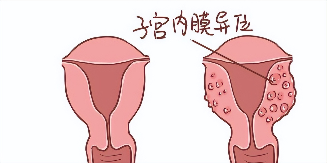 妇科病严重也怀孕了有影响吗,女性哪些妇科病会导致不孕