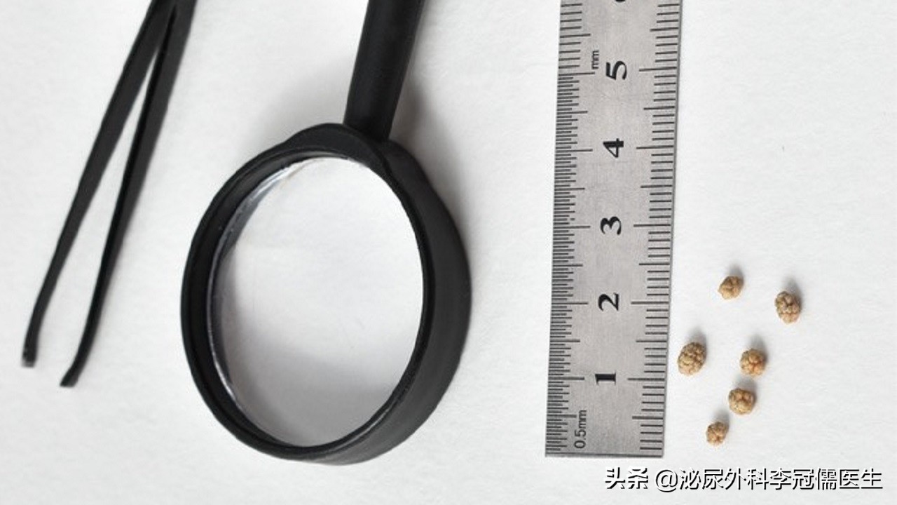 怎样能彻底根治尿结石,尿路结石怎么快速缓解尿意