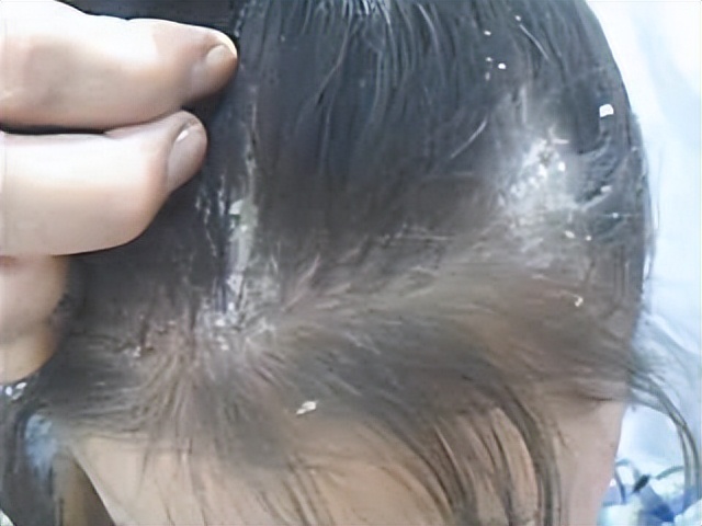 头皮总长小疙瘩和脓包怎么治疗,如何改善头皮长脓包和疙瘩的问题