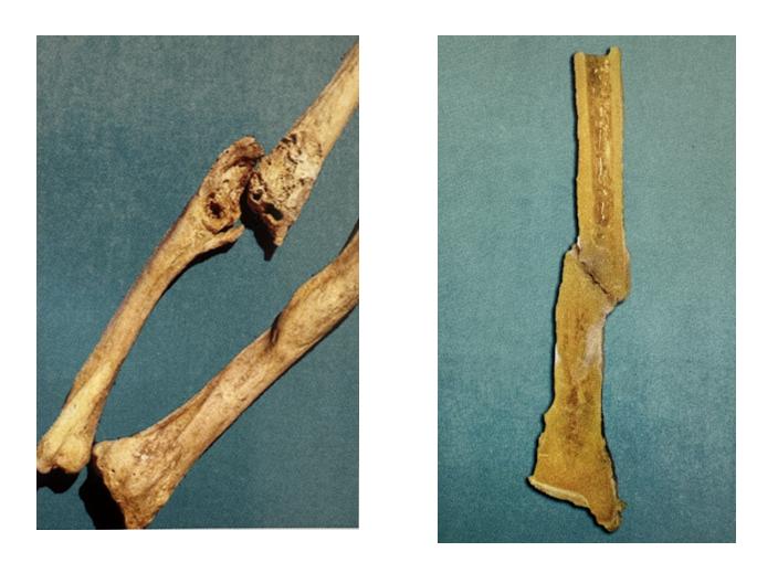 治疗骨折新技术,微创手术治疗骨折的方法