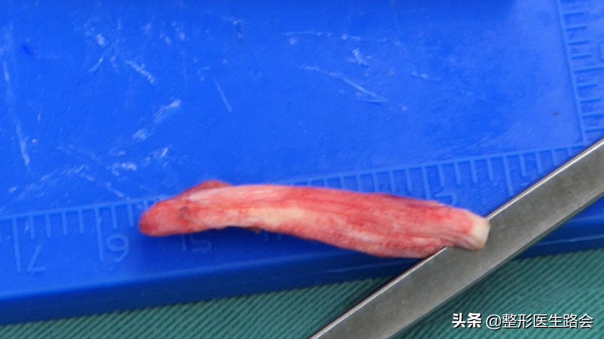 做膨体隆鼻感染了怎么办,膨体隆鼻注意事项