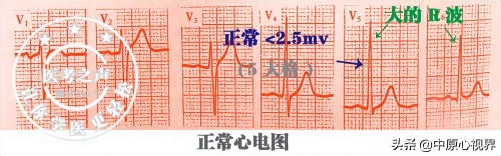 护考几种常见的心电图,常见的心电图图形分析