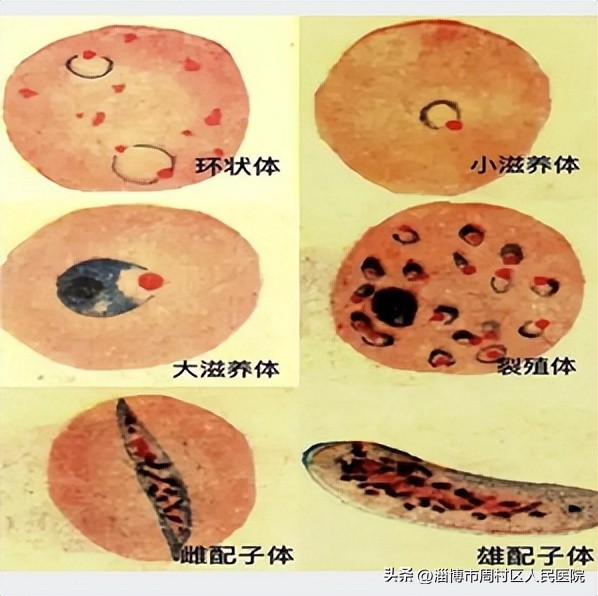 高热健康科普,寒战高热是什么病的表现