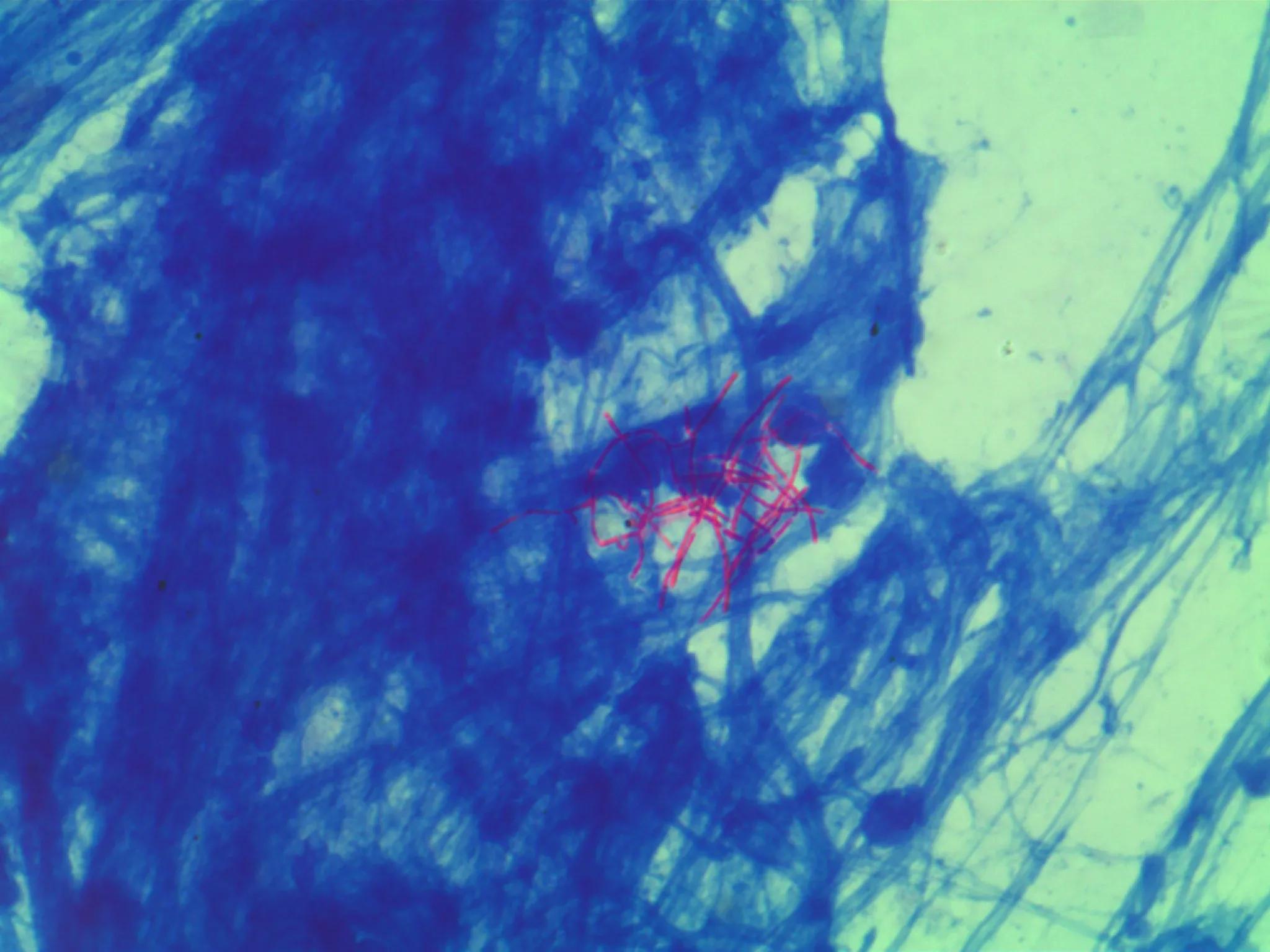 奴卡菌和结核菌,奴卡菌属于非结核分枝杆菌吗