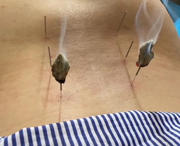 温针治疗肾虚腰痛一例