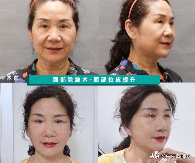 电波拉皮眼部除皱有后遗症吗,做拉皮除皱有风险吗