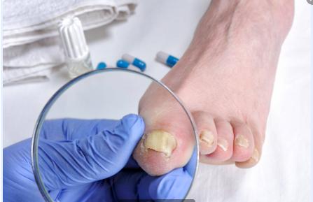 灰指甲和脚气有什么妙招,脚气引起灰指甲全过程