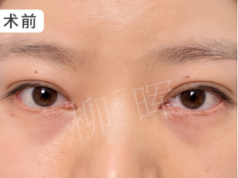 鎵撶幓灏块吀鍙互璧峰埌鎶楄“鐨勪綔鐢ㄥ悧,22宀佹墦浜嗙幓灏块吀