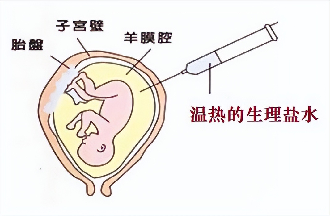 32周羊水少住院补水有效吗,四维彩超羊水少怎么补最有效