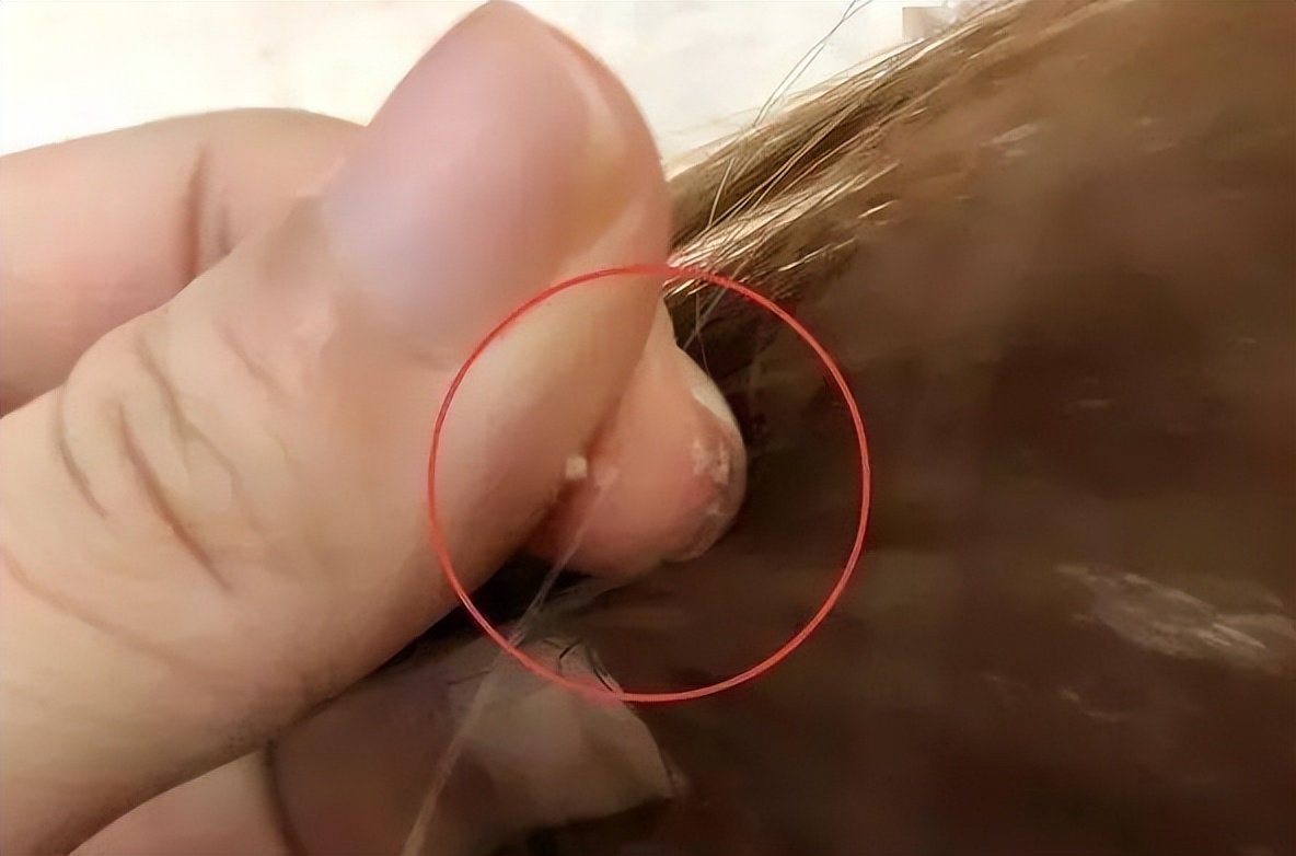 指甲抓头皮有白色的泥,头皮总能抠下来白泥