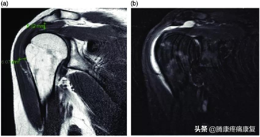 注射疫苗后的肩部疼痛
