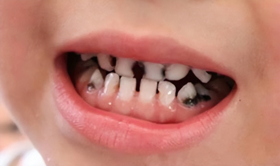 宝宝牙缝大是吃糖引起的吗,宝宝牙缝太宽了吧