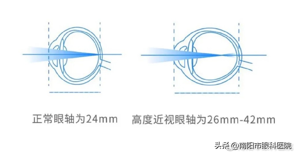 近视了不戴眼镜会更严重吗,近视不戴眼镜为什么会越来越严重