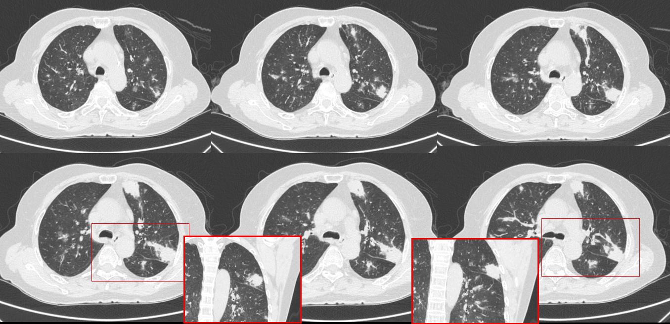 肉芽肿性血管炎ct表现,嗜酸性肉芽肿性血管炎症状