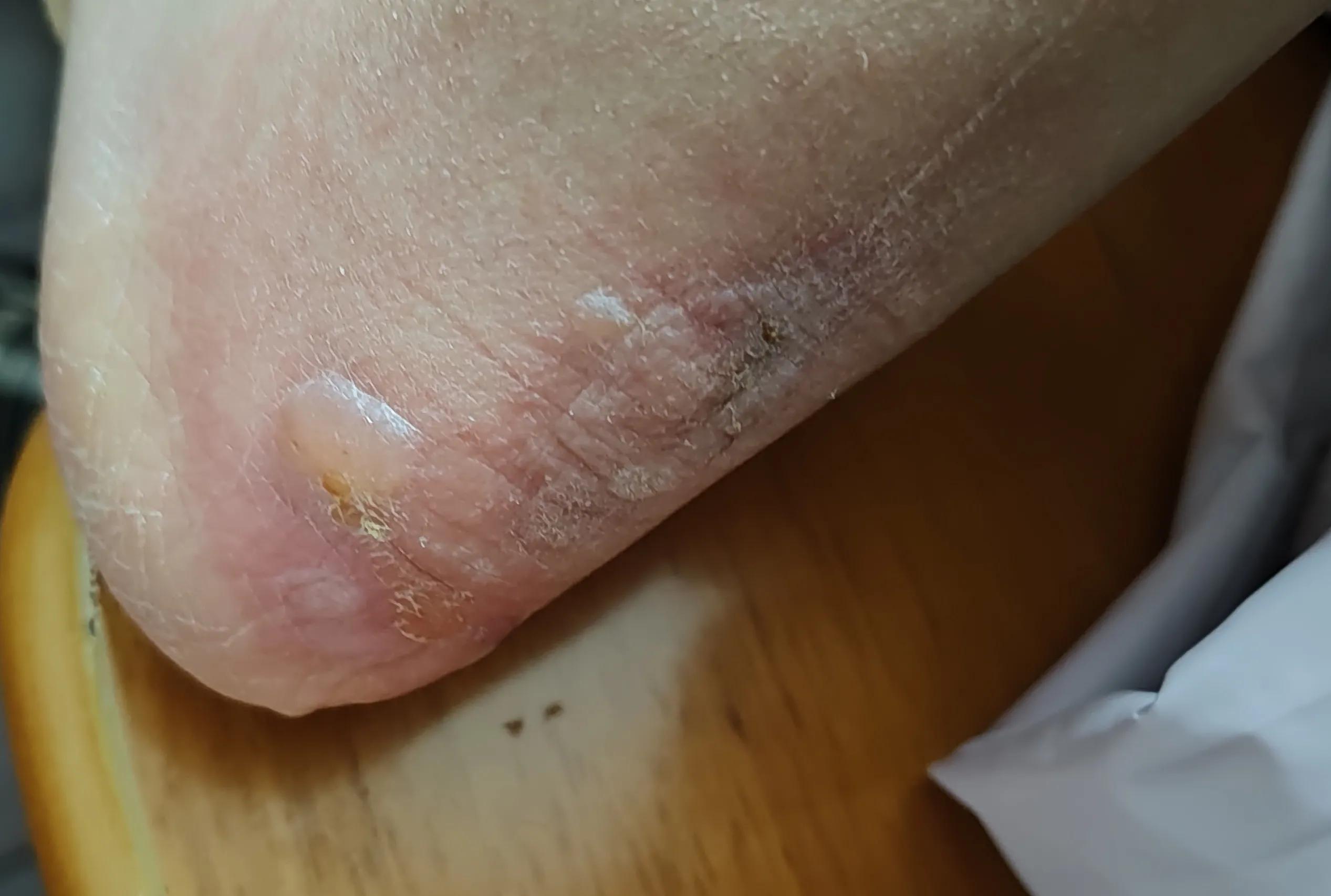 脚后跟红肿起硬皮怎么办,脚后跟红肿怎么处理