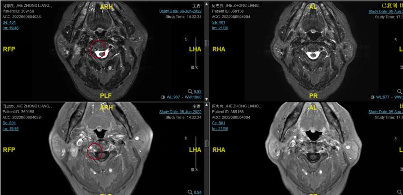 一例Ⅲ期鼻咽癌患者接受同步放化疗联合斯鲁利单抗治疗的经验分享