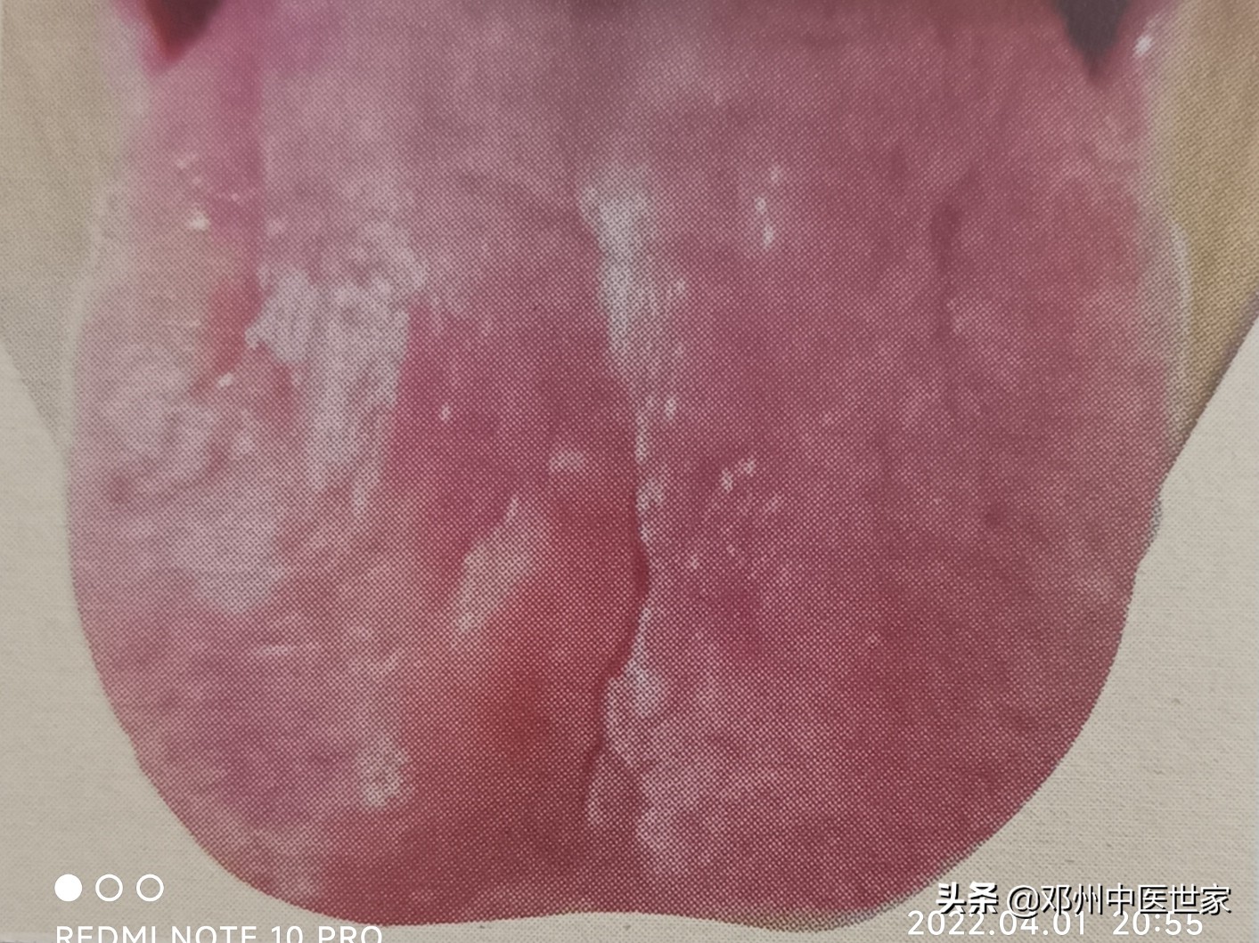 胸痹的舌象有哪些,肾阴亏虚胸痹的治疗方法