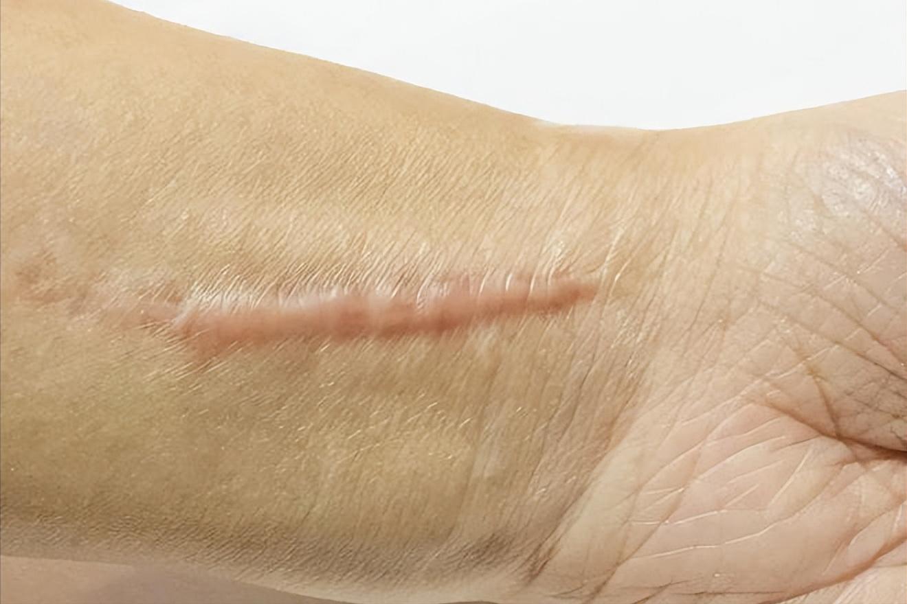 瘢痕疙瘩怎么治疗复发率小,瘢痕疙瘩持续增长怎么办