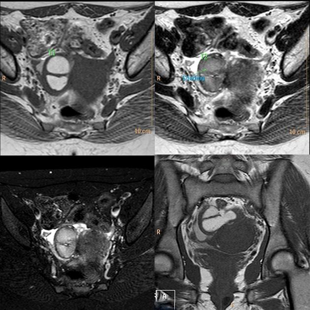MRI如何评估子宫内膜异位症？这10个病例会帮助您