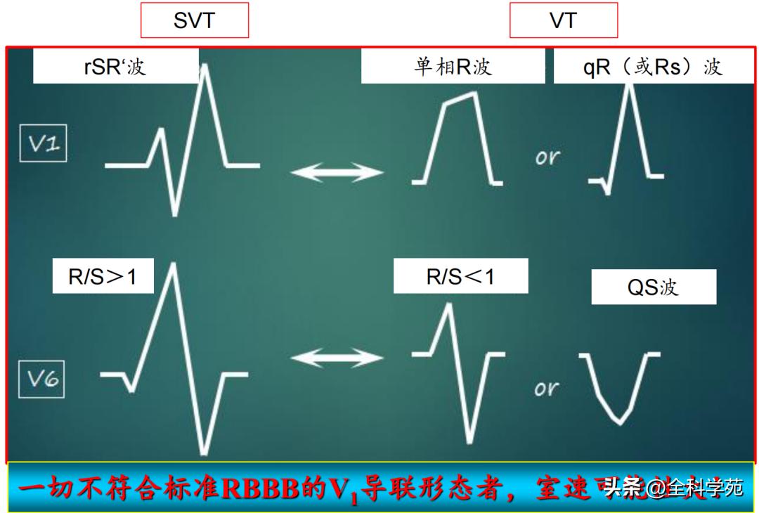 心电图上表现为宽qrs波,心电图中qrs是代表心动过速吗